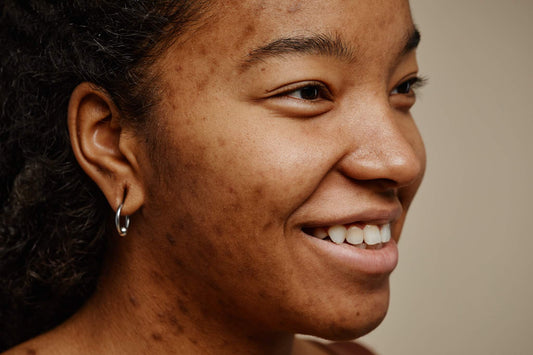 Femme présentant des taches brunes et une hyperpigmentation du visage avant l'utilisation d'un sérum anti-taches.