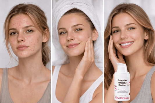Tes imperfections ne sont pas un manque d’hygiène - OnaBeauty