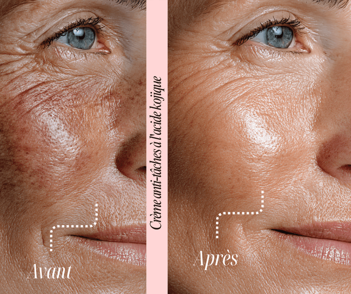 Crème anti - tâches à l'acide kojique - OnaBeauty