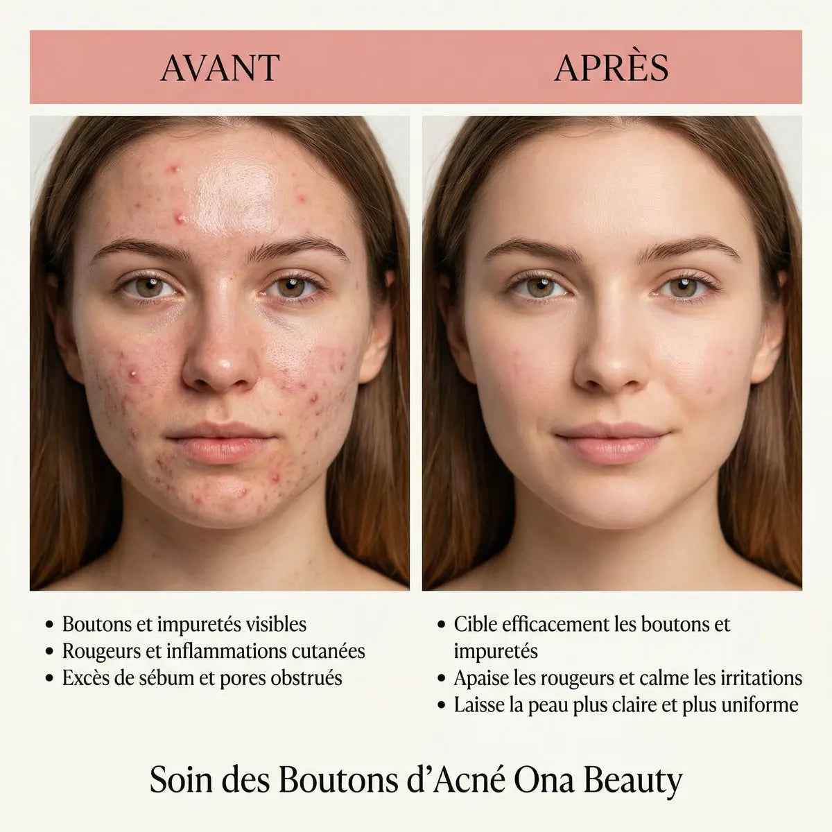 Soin ciblé boutons d'acné – Traitement rapide OnaBeauty